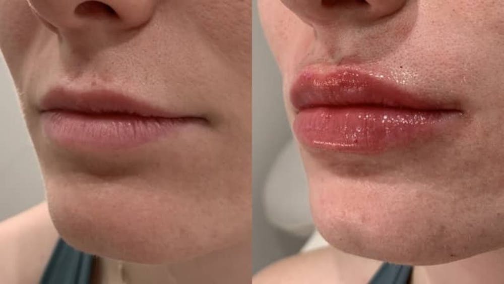 Fillers Before & After Gallery - Patient 166736871 - Image 2