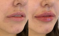 Fillers Before & After Gallery - Patient 166736874 - Image 1