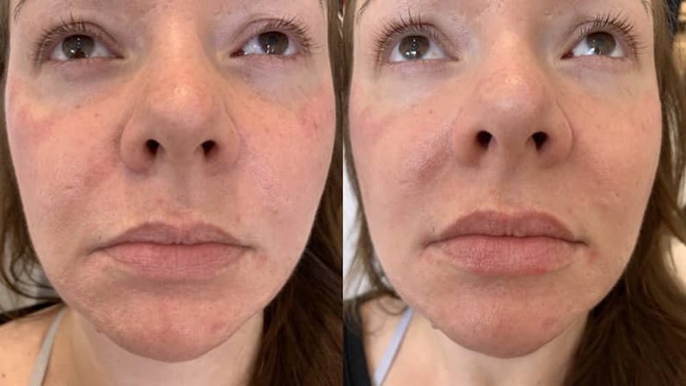 Fillers Before & After Gallery - Patient 166736875 - Image 1