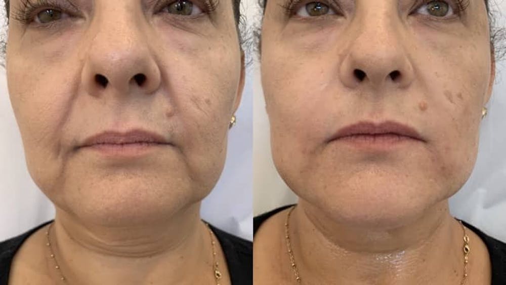 Fillers Before & After Gallery - Patient 166736876 - Image 1