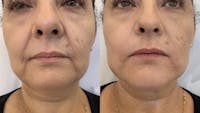 Fillers Before & After Gallery - Patient 166736876 - Image 1