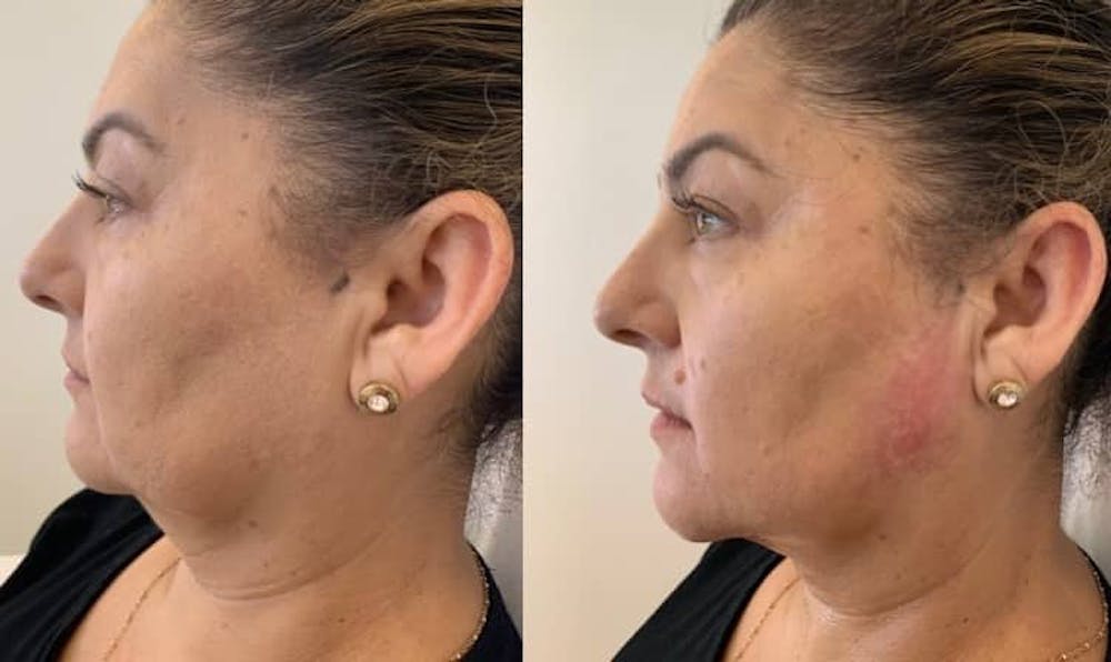 Fillers Before & After Gallery - Patient 166736876 - Image 2