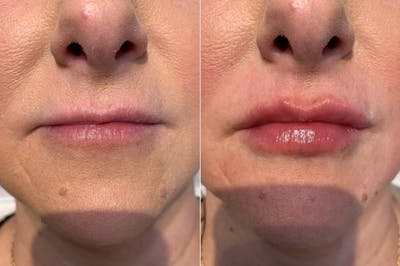 Fillers Before & After Gallery - Patient 166736877 - Image 1