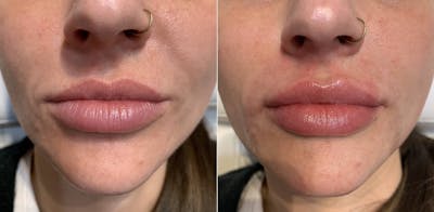 Fillers Before & After Gallery - Patient 166736879 - Image 1