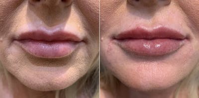 Fillers Before & After Gallery - Patient 166736880 - Image 1