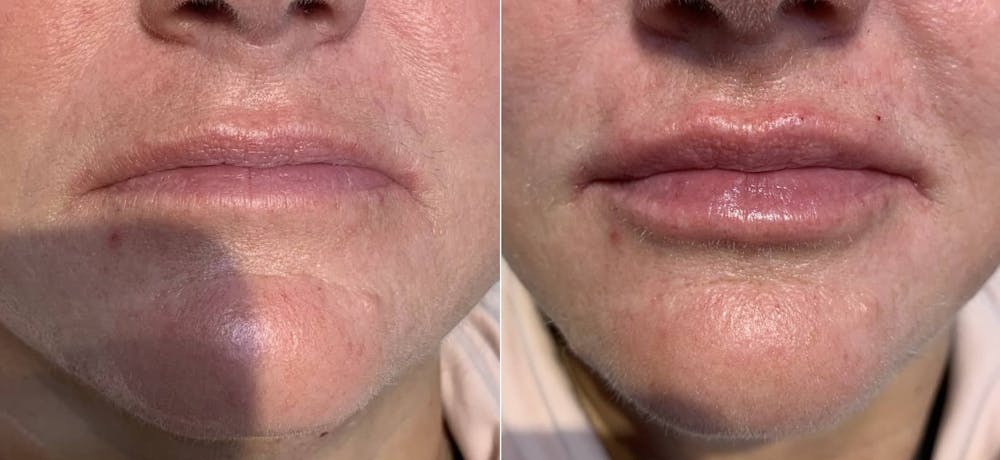 Fillers Before & After Gallery - Patient 166736882 - Image 1