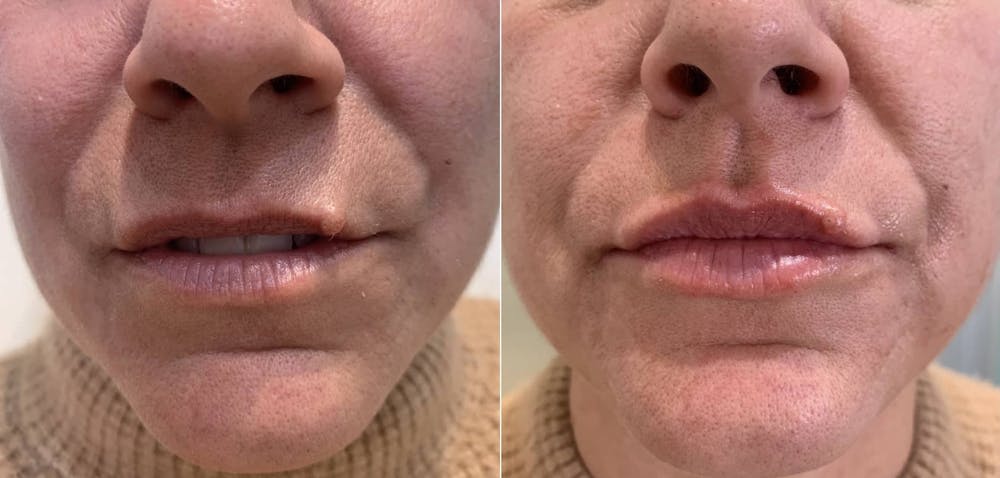 Fillers Before & After Gallery - Patient 166736884 - Image 1