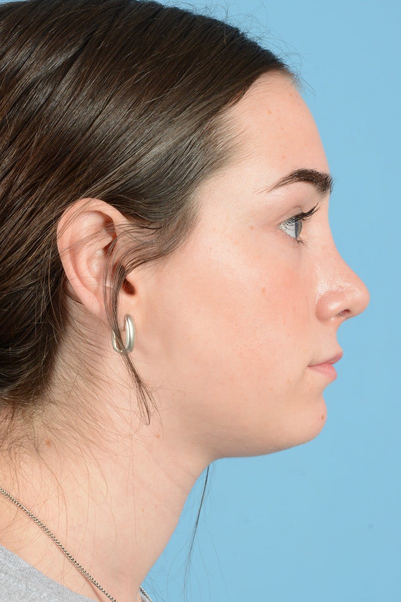 Rhinoplasty Before & After Gallery - Patient 187818215 - Image 7