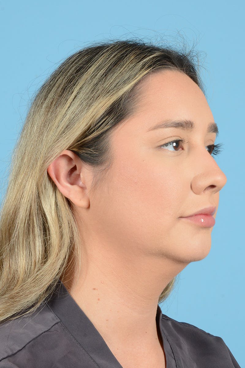 Rhinoplasty Before & After Gallery - Patient 187816949 - Image 3