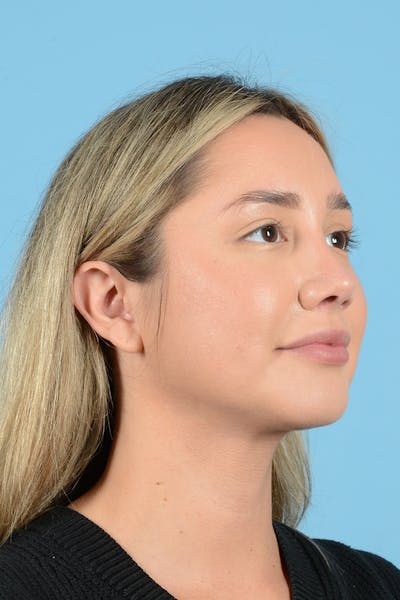 Rhinoplasty Before & After Gallery - Patient 187816949 - Image 4