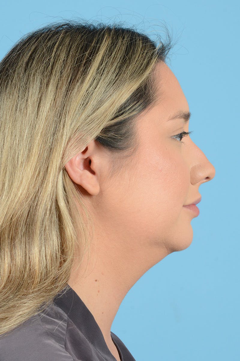 Rhinoplasty Before & After Gallery - Patient 187816949 - Image 5