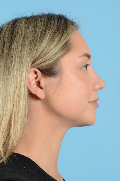Rhinoplasty Before & After Gallery - Patient 187816949 - Image 6