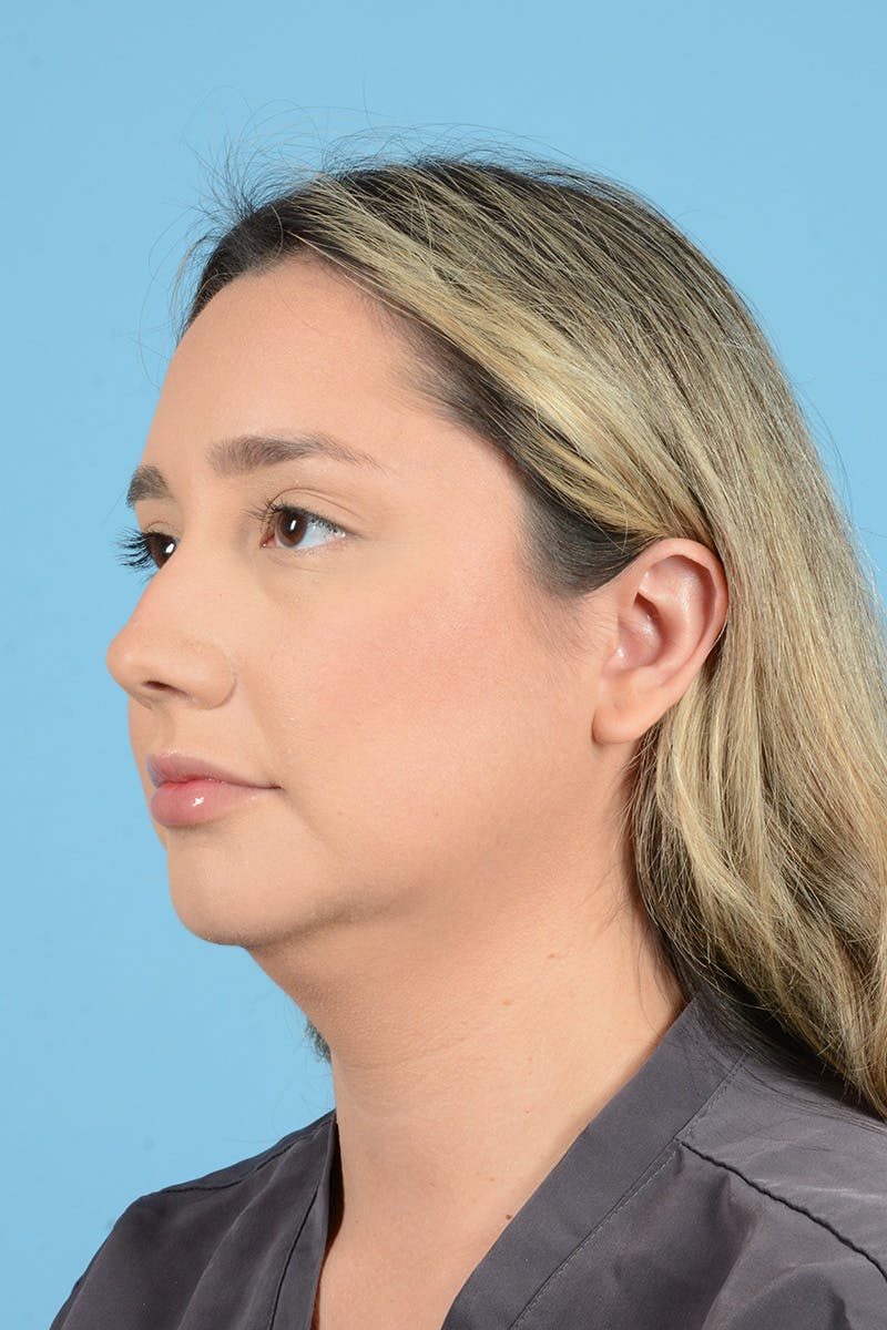 Rhinoplasty Before & After Gallery - Patient 187816949 - Image 7