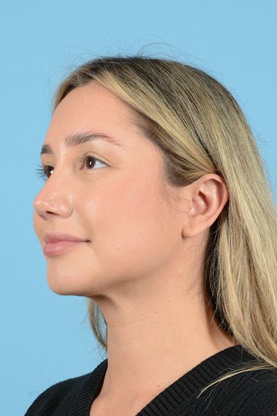 Rhinoplasty Before & After Gallery - Patient 187816949 - Image 8