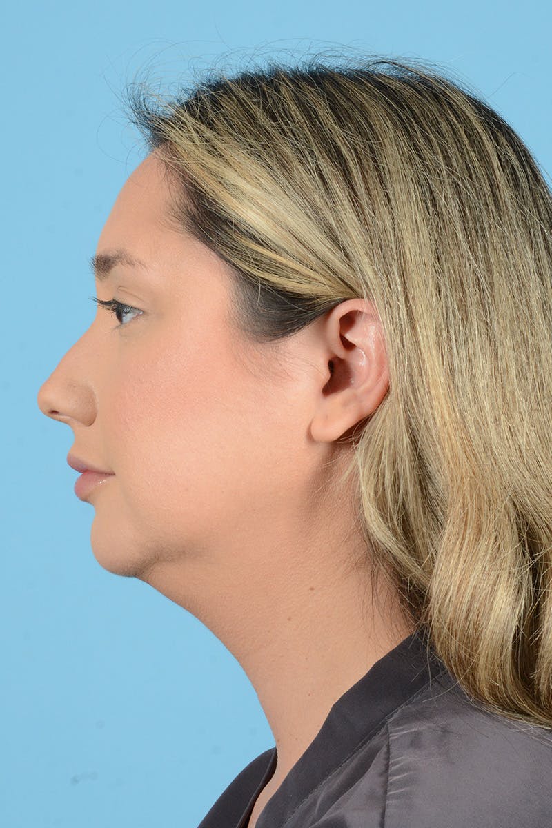 Rhinoplasty Before & After Gallery - Patient 187816949 - Image 9