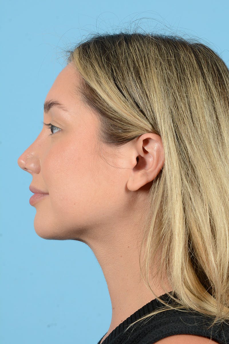 Rhinoplasty Before & After Gallery - Patient 187816949 - Image 10