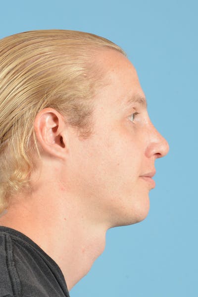 Rhinoplasty Before & After Gallery - Patient 187817617 - Image 6