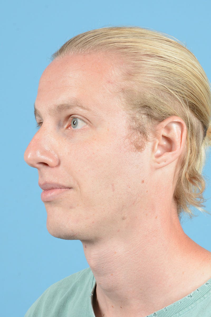Rhinoplasty Before & After Gallery - Patient 187817617 - Image 7