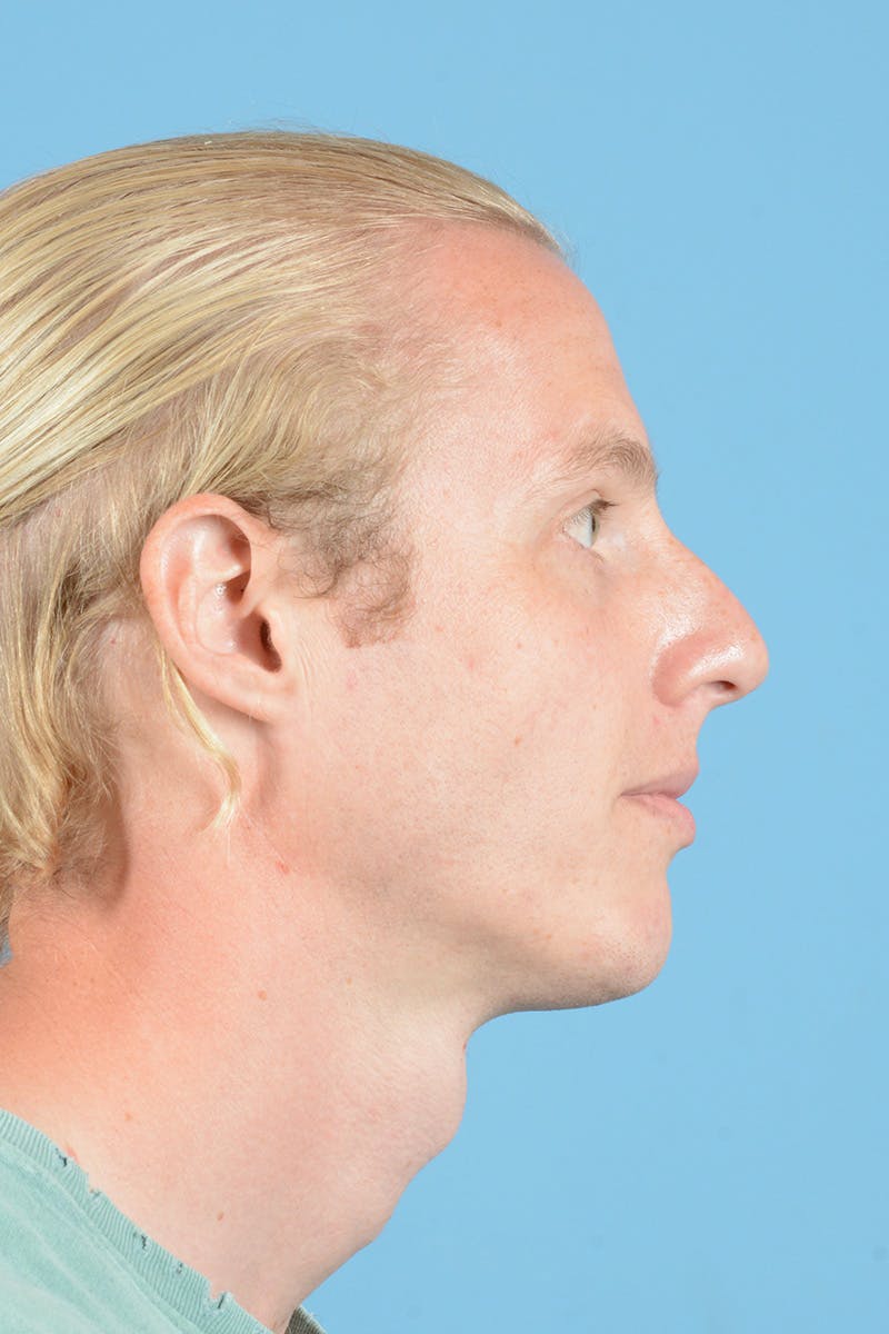 Rhinoplasty Before & After Gallery - Patient 187817617 - Image 5