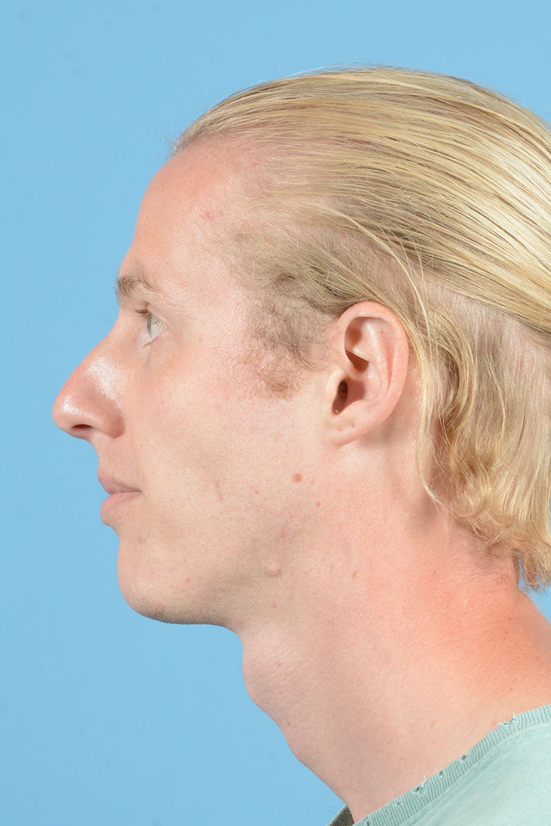 Rhinoplasty Before & After Gallery - Patient 187817617 - Image 9