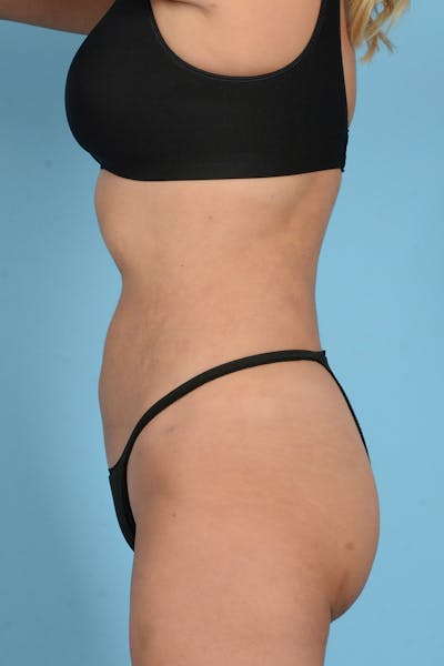 Liposuction Before & After Gallery - Patient 187824315 - Image 10