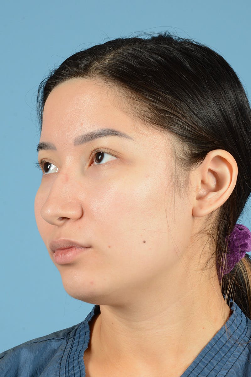 Rhinoplasty Before & After Gallery - Patient 187818234 - Image 7