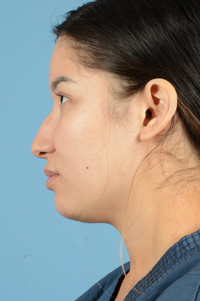 Rhinoplasty Before & After Gallery - Patient 187818234 - Image 9