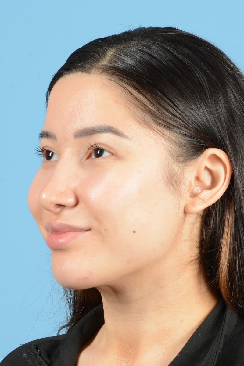 Facial Augmentation Before & After Gallery - Patient 187823949 - Image 8