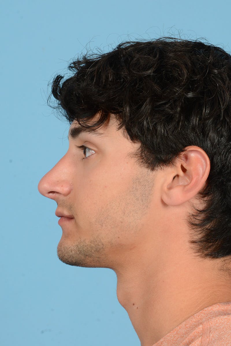 Rhinoplasty Before & After Gallery - Patient 187818265 - Image 9