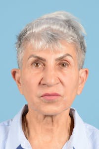 Facelift Before & After Gallery - Patient 187823711 - Image 1