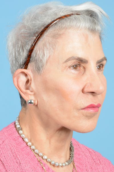 Facelift Before & After Gallery - Patient 187823711 - Image 4