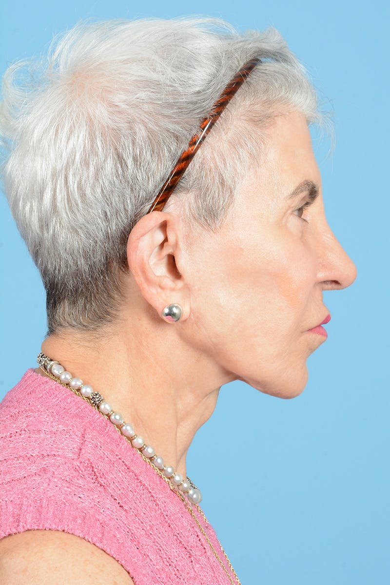 Neck Lift Before & After Gallery - Patient 187823713 - Image 6