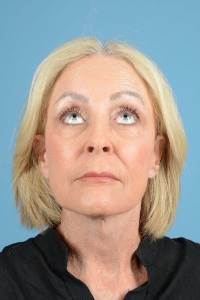 Facelift Before & After Gallery - Patient 122226587 - Image 6