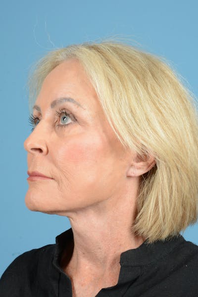 Facelift Before & After Gallery - Patient 122226587 - Image 8