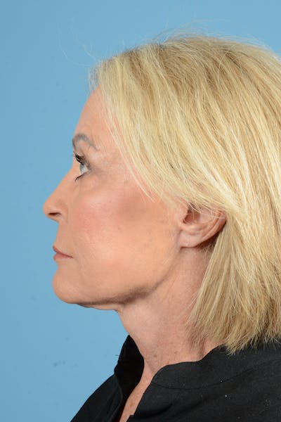 Facelift Before & After Gallery - Patient 122226587 - Image 10