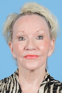 Facelift Before & After Gallery - Patient 187823697 - Image 1