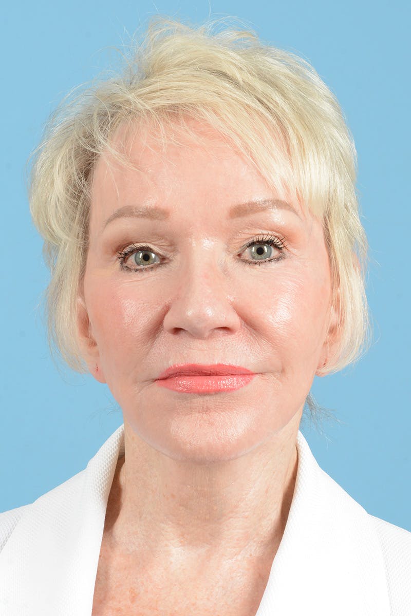 Facelift Before & After Gallery - Patient 187823697 - Image 2