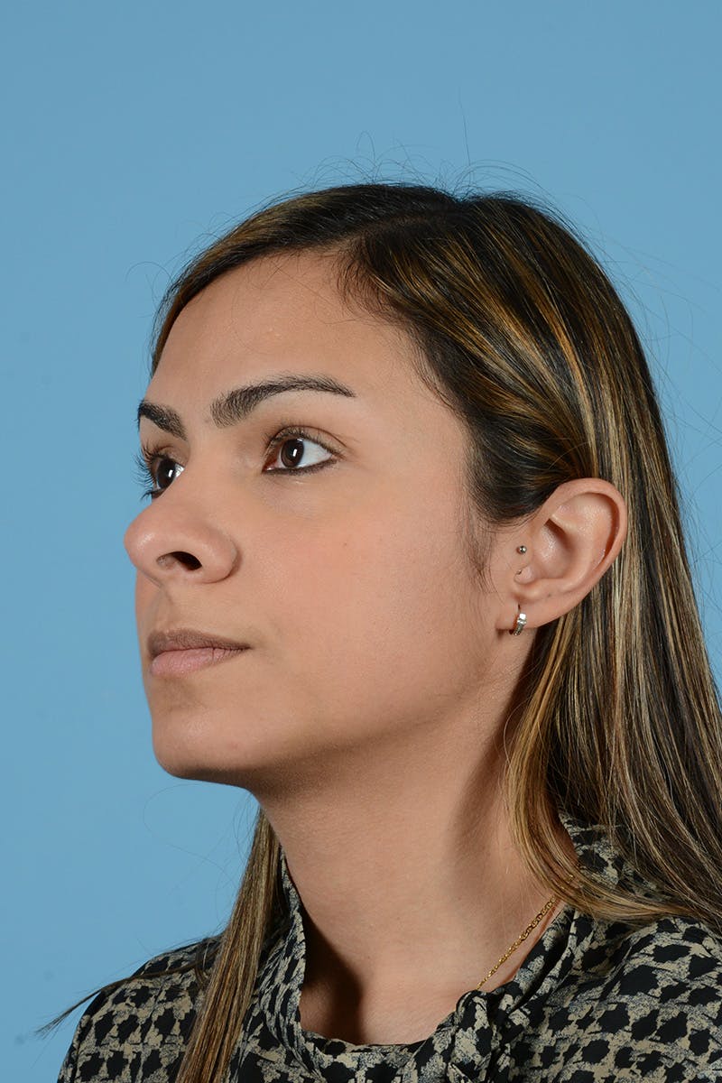 Rhinoplasty Before & After Gallery - Patient 404359 - Image 7
