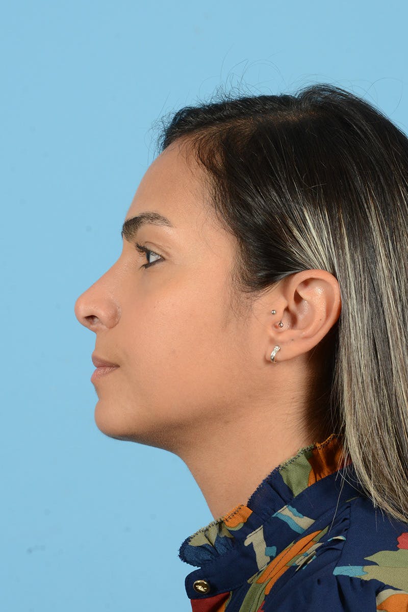 Rhinoplasty OLD Before & After Gallery - Patient 404359 - Image 10