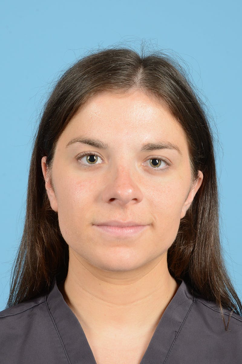 Rhinoplasty OLD Before & After Gallery - Patient 320508 - Image 1
