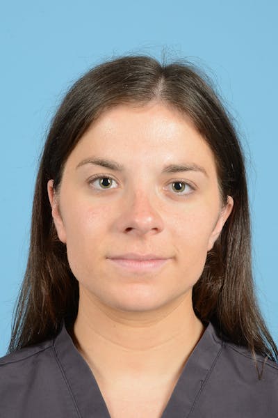 Rhinoplasty OLD Before & After Gallery - Patient 320508 - Image 1