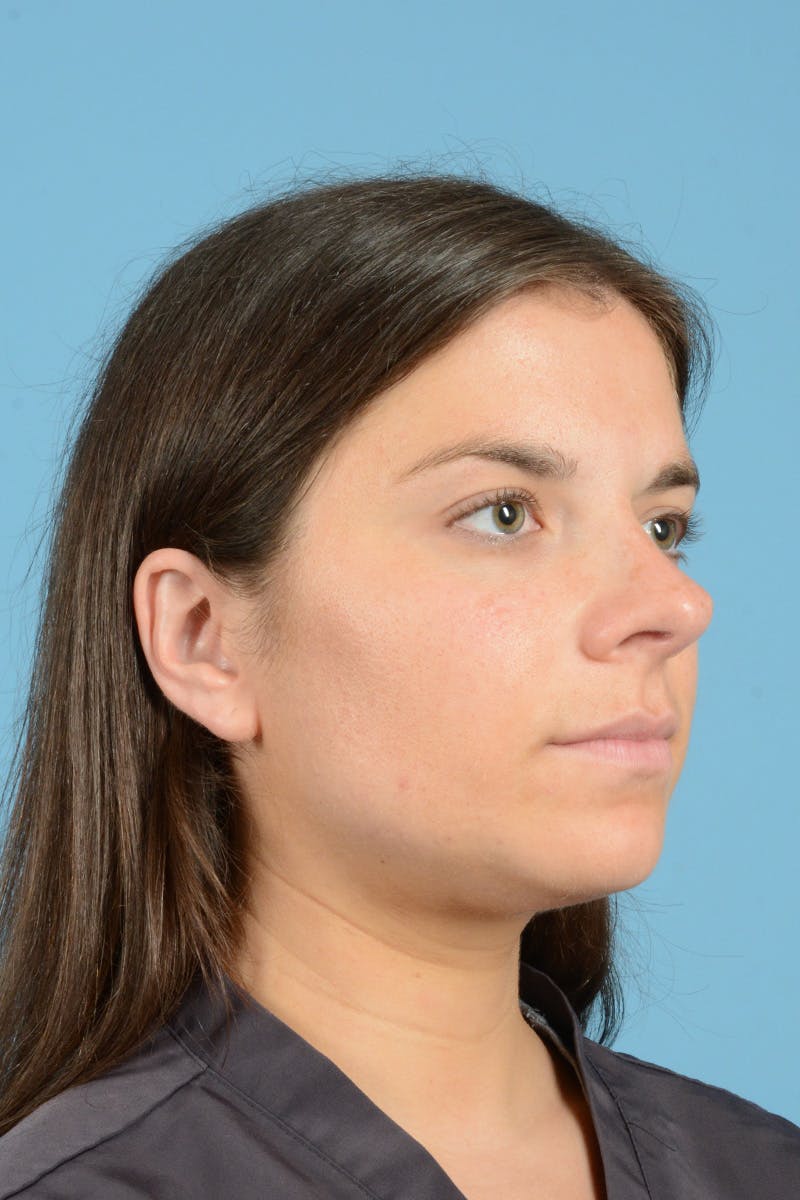 Rhinoplasty Before & After Gallery - Patient 320508 - Image 3