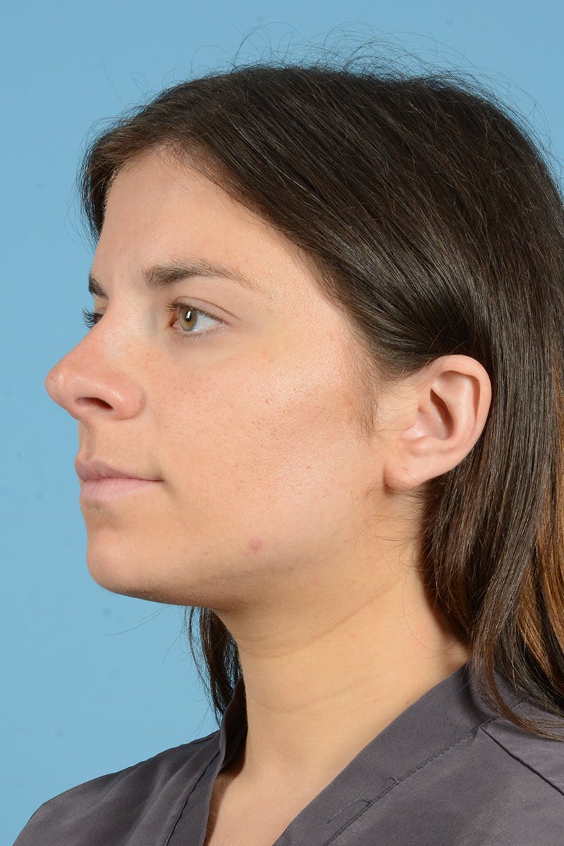 Rhinoplasty Before & After Gallery - Patient 320508 - Image 7