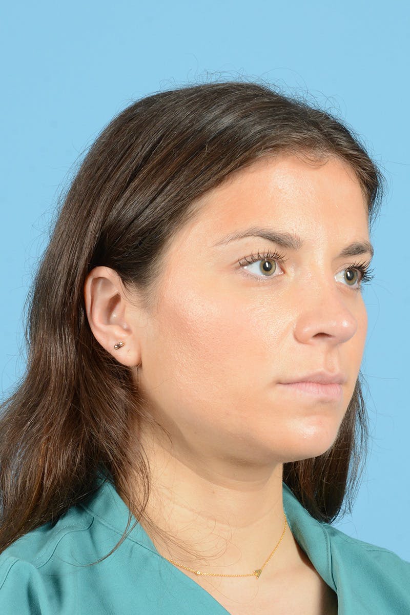 Rhinoplasty Before & After Gallery - Patient 320508 - Image 4