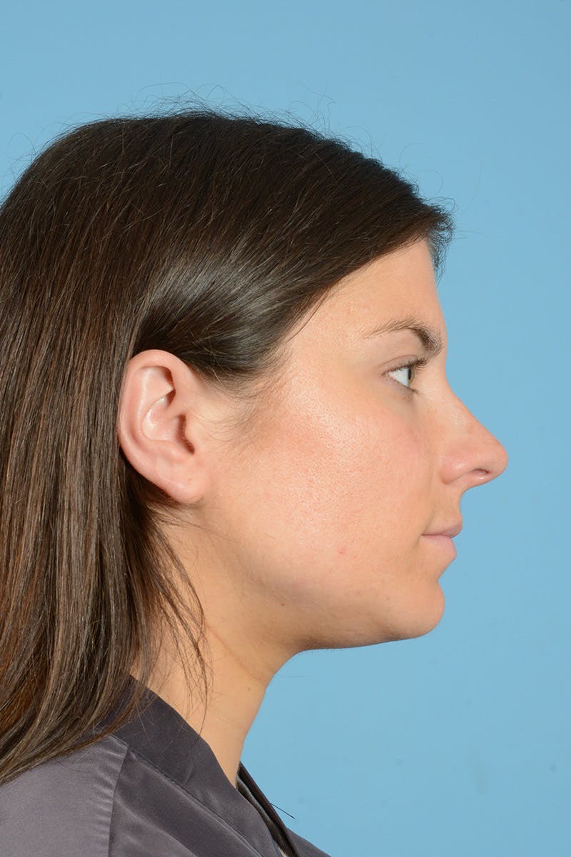 Rhinoplasty Before & After Gallery - Patient 320508 - Image 5