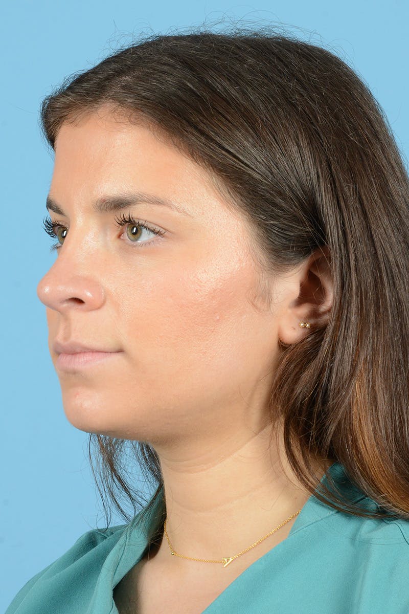 Rhinoplasty Before & After Gallery - Patient 320508 - Image 8
