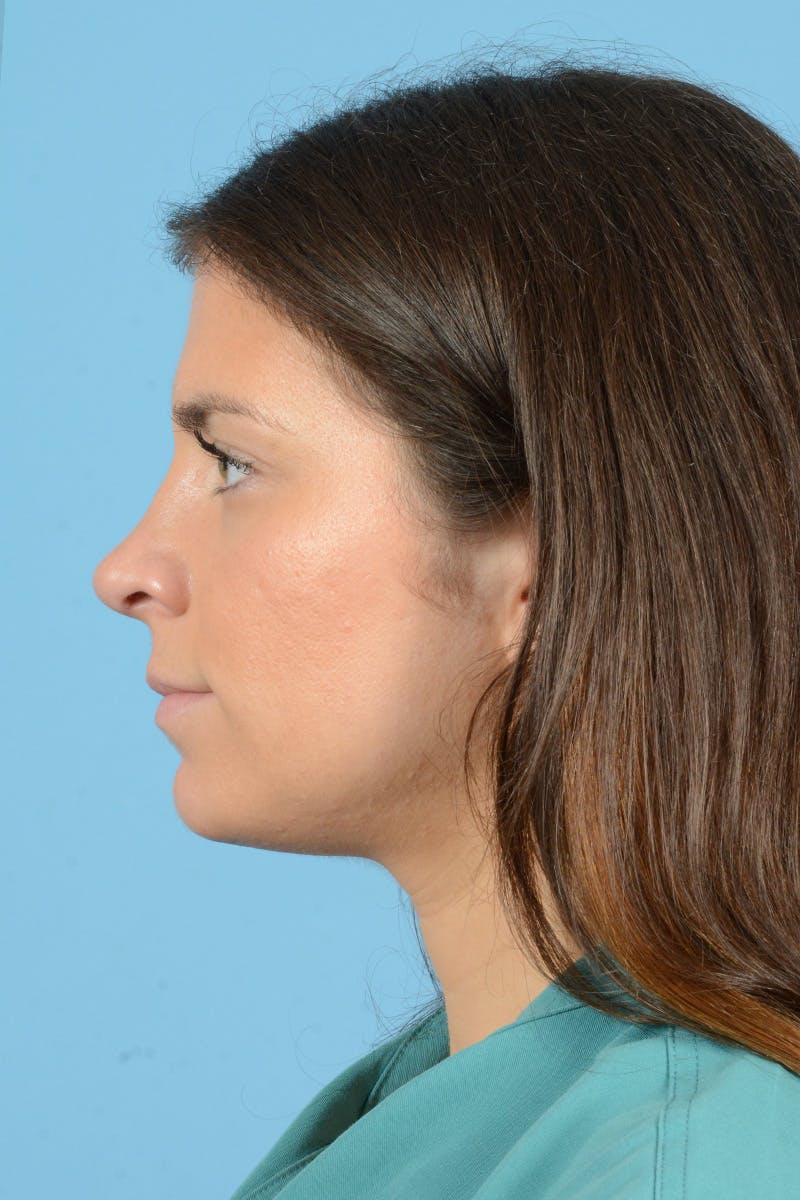 Rhinoplasty Before & After Gallery - Patient 320508 - Image 10