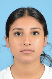 Rhinoplasty Before & After Gallery - Patient 370165 - Image 1