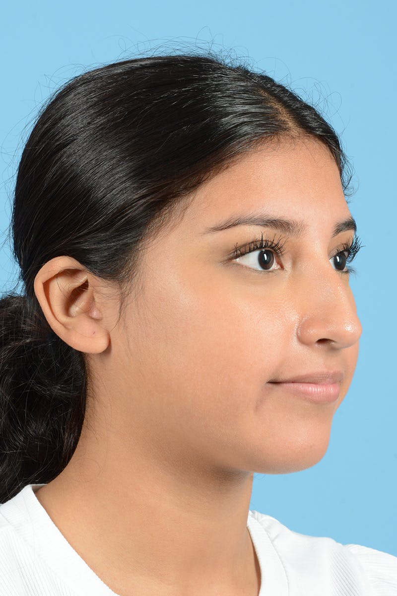 Rhinoplasty Before & After Gallery - Patient 370165 - Image 3