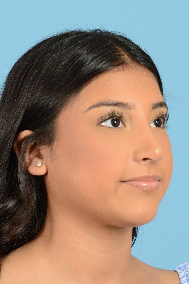 Rhinoplasty Before & After Gallery - Patient 370165 - Image 4